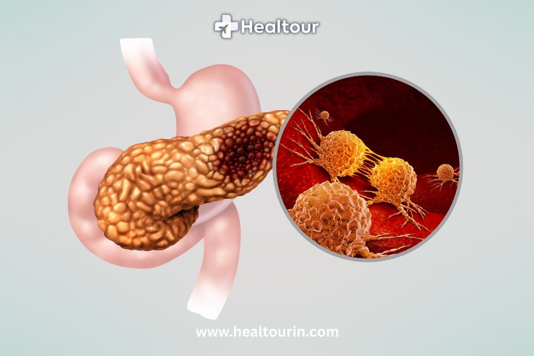 Pancreatic Cancer Surgery in India | Cost, Care & Treatment