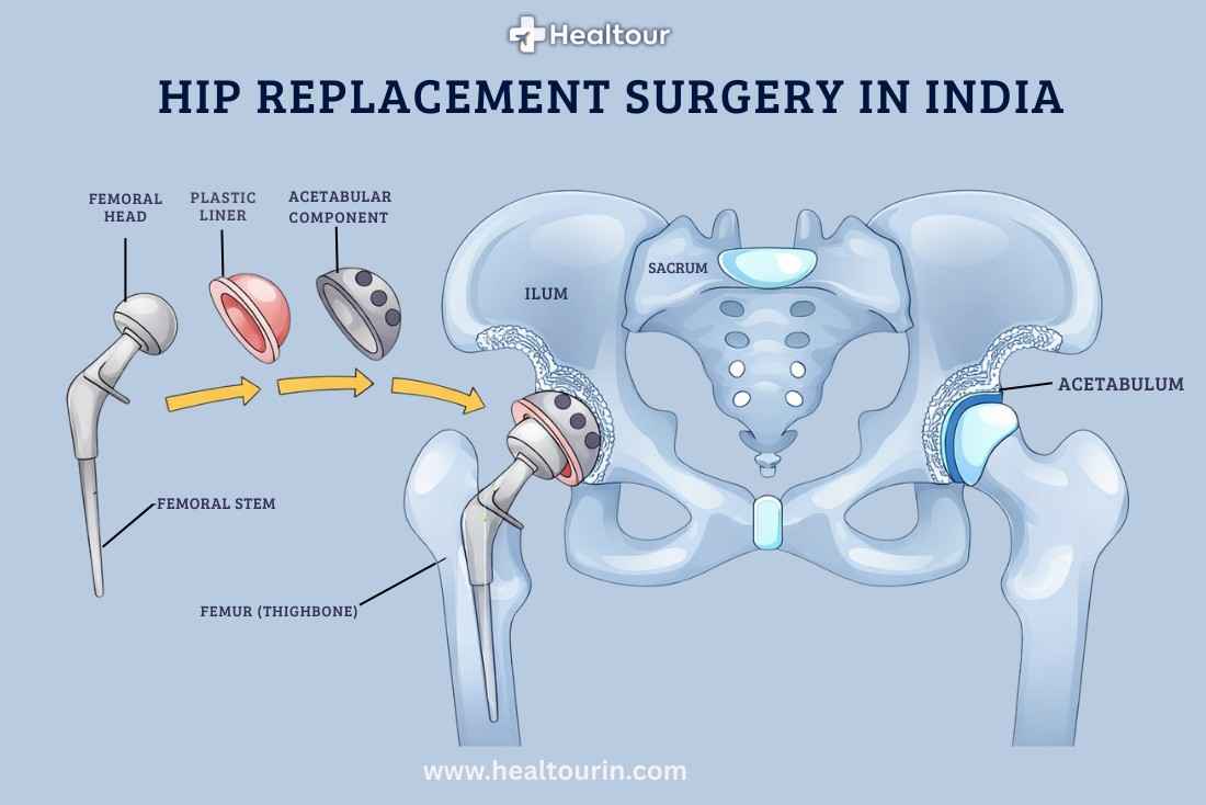 Hip Replacement Surgery in India | Types, Cost & Recovery 2026