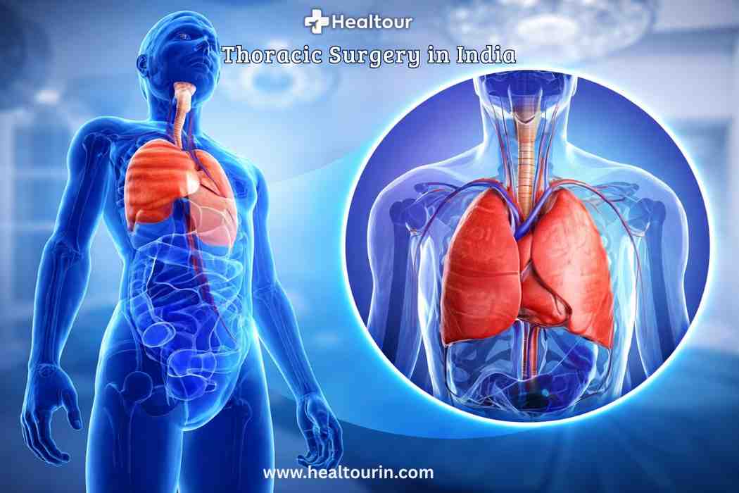 Thoracic Surgery in India: Types, Procedure, Cost & Recovery 2026