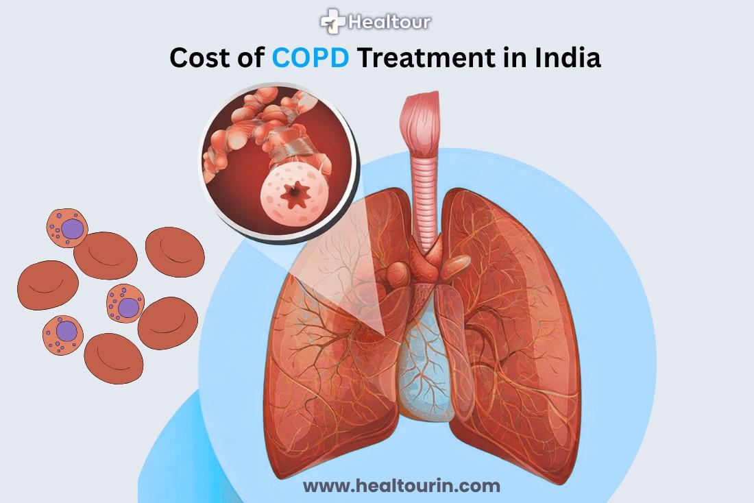 COPD Treatment Cost in India: Types, Cost & Recovery-2026