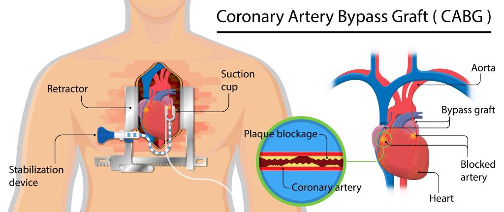 Coronary Artery Bypass Grafting (CABG)