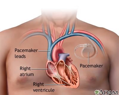 Pacemaker Implantation