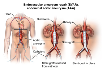 Aortic Aneurysm Repair