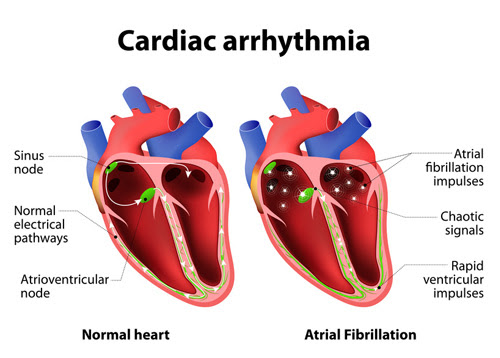 Arrhythmia Treatment 