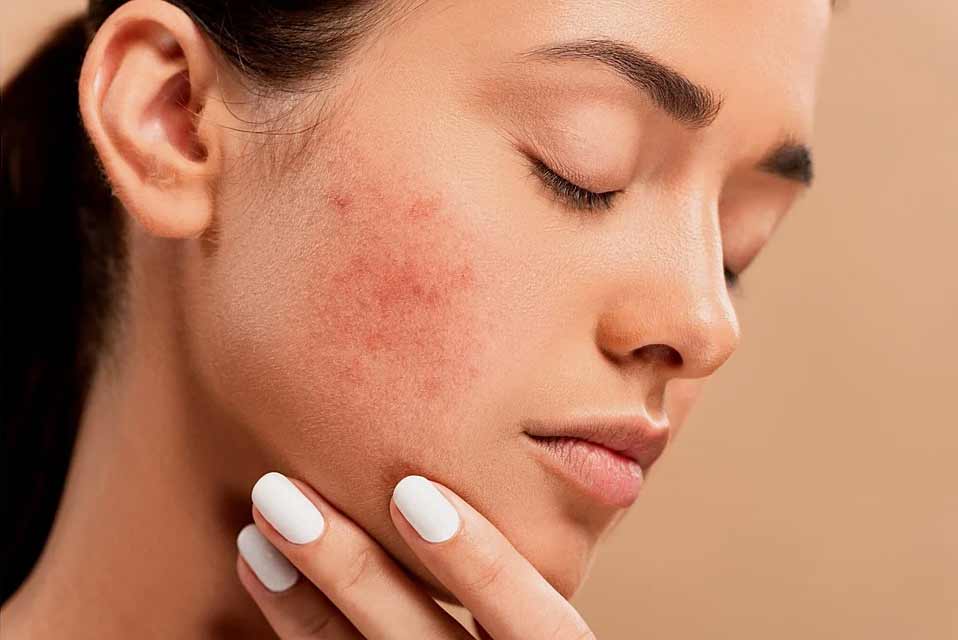 Acne & Skin Condition Treatment