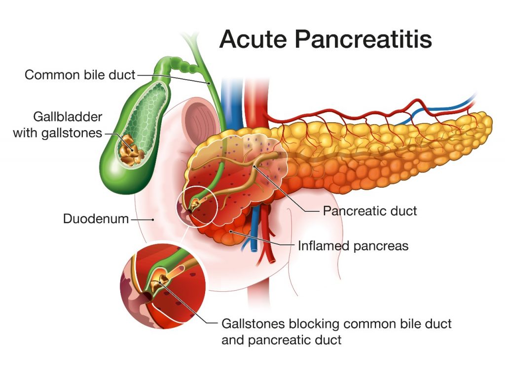 Pancreatitis Treatment