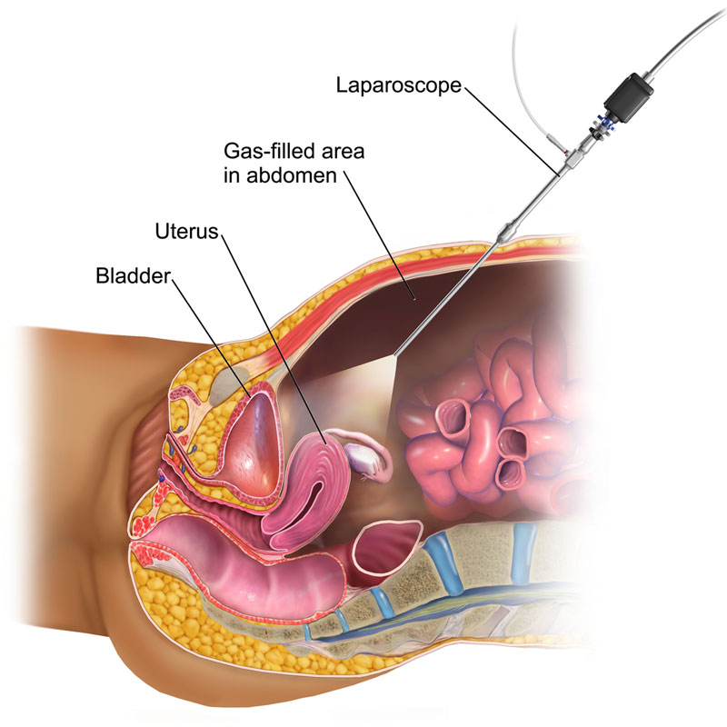 Laparoscopic Surgery