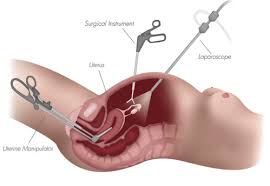 Hysterectomy (Laparoscopic/Traditional)