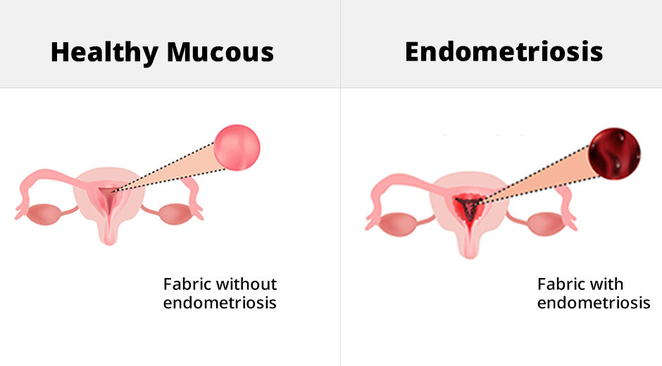 Endometriosis Treatment