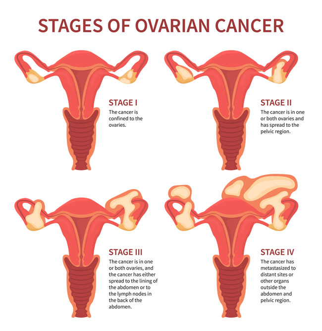 Ovarian Cancer Surgery