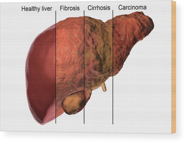 Liver Disease Diagnosis and Management