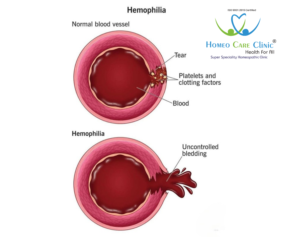 Blood Disorder Treatment (Anemia, Hemophilia)