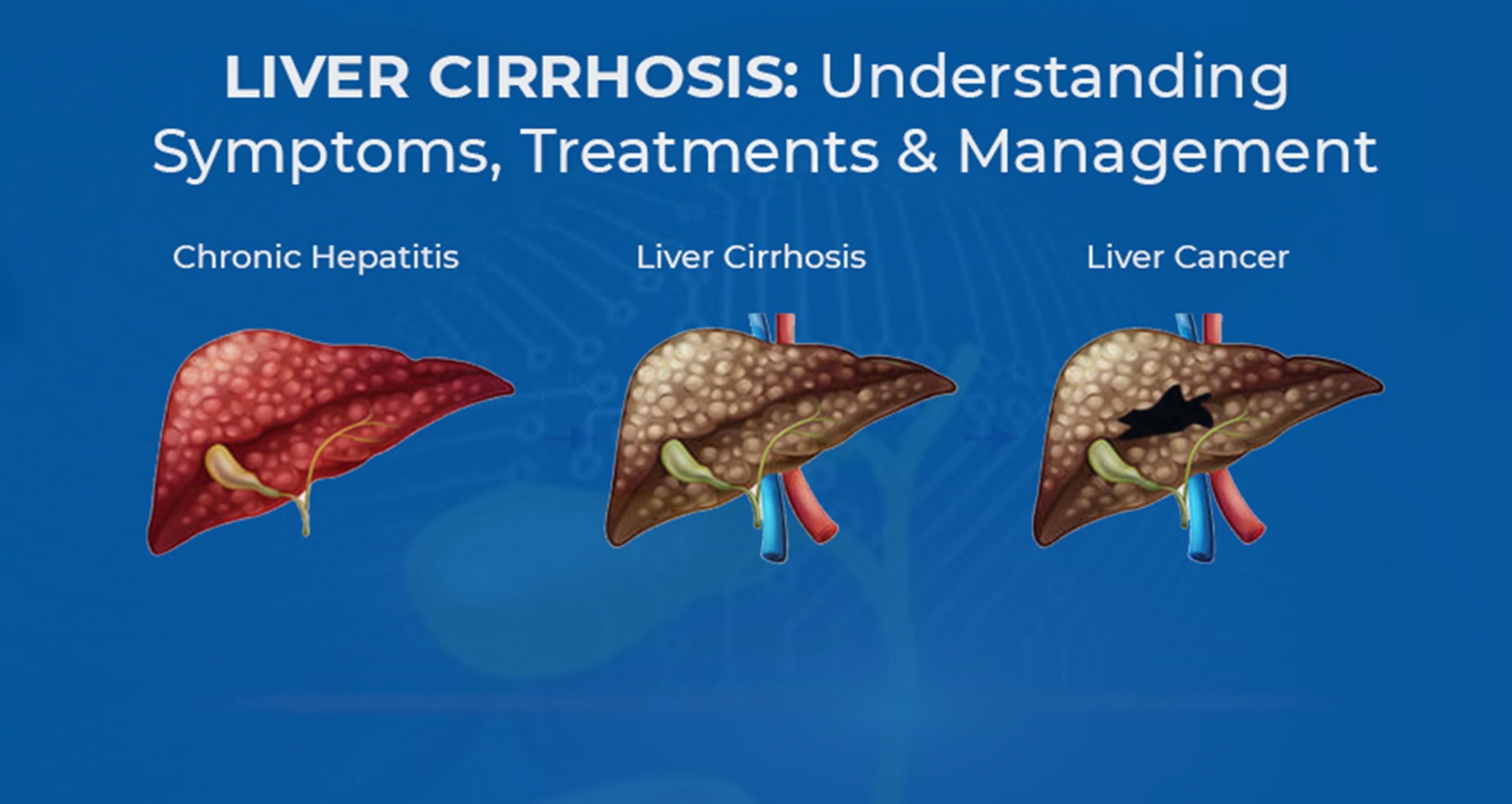Cirrhosis Management