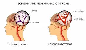 Stroke Treatment