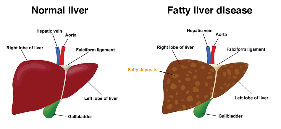 Fatty Liver Disease Treatment