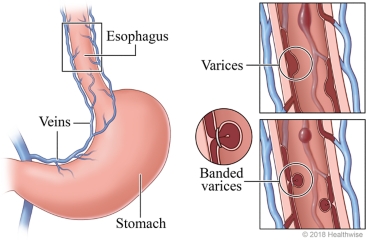 Endoscopic Variceal Banding