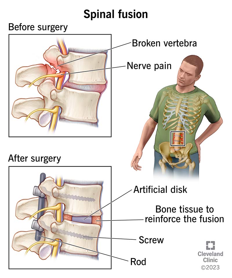 Spinal Cord Surgery