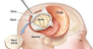 Brain Tumor Surgery