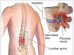 Spinal Surgery