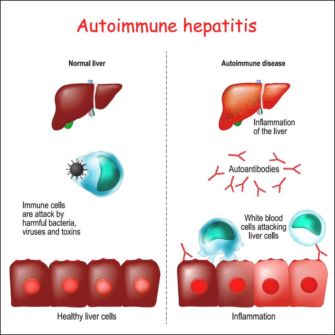 Autoimmune Liver Disease Treatment