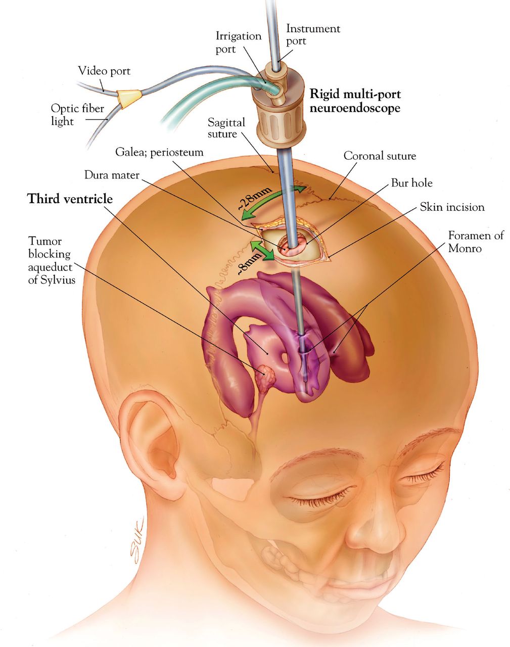 Endoscopic Neurosurgery