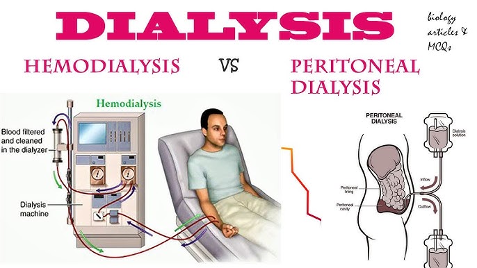 Dialysis (Hemodialysis, Peritoneal)