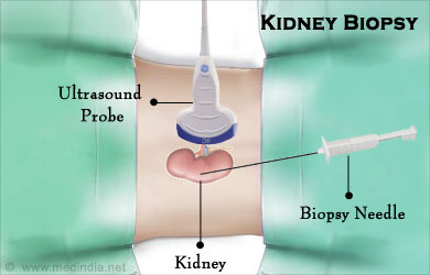 Renal Biopsy