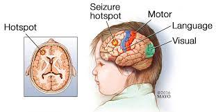 Epilepsy Surgery