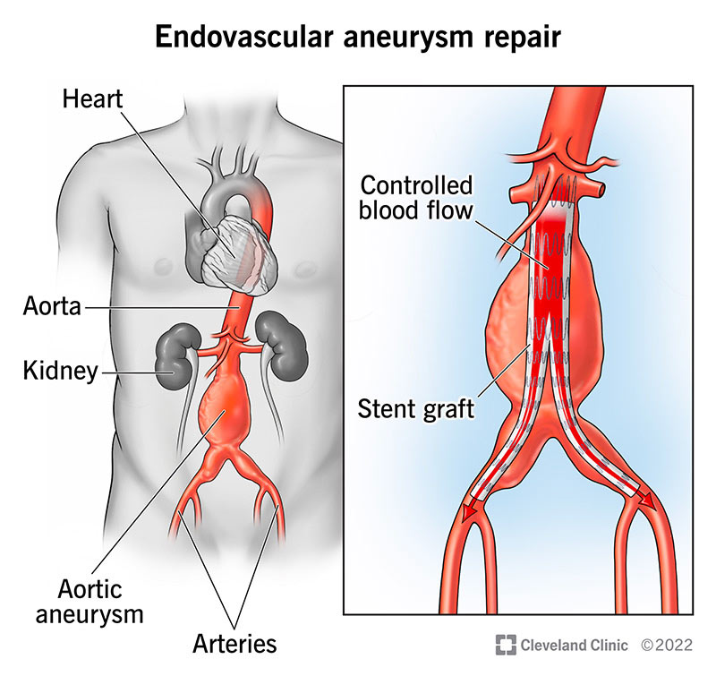 Aneurysm Repair Surgery