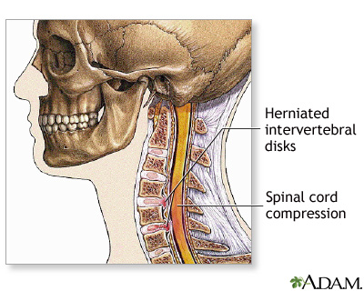 Cervical Spine Surgery