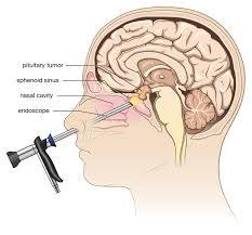 Pituitary Tumor Surgery