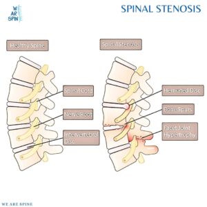 Spinal Cord Injury Surgery