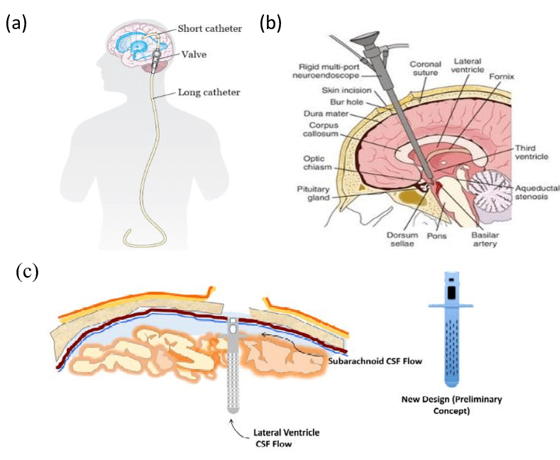 Hydrocephalus Treatment (Shunt Placement)