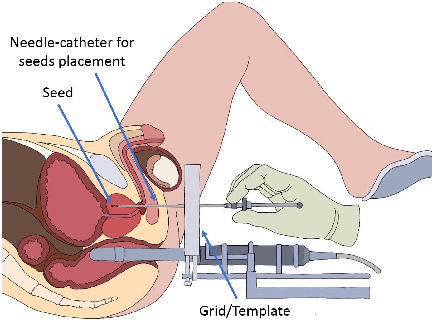 Brachytherapy