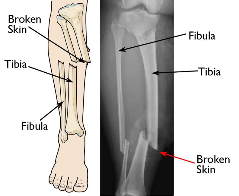 Complex Fracture Management