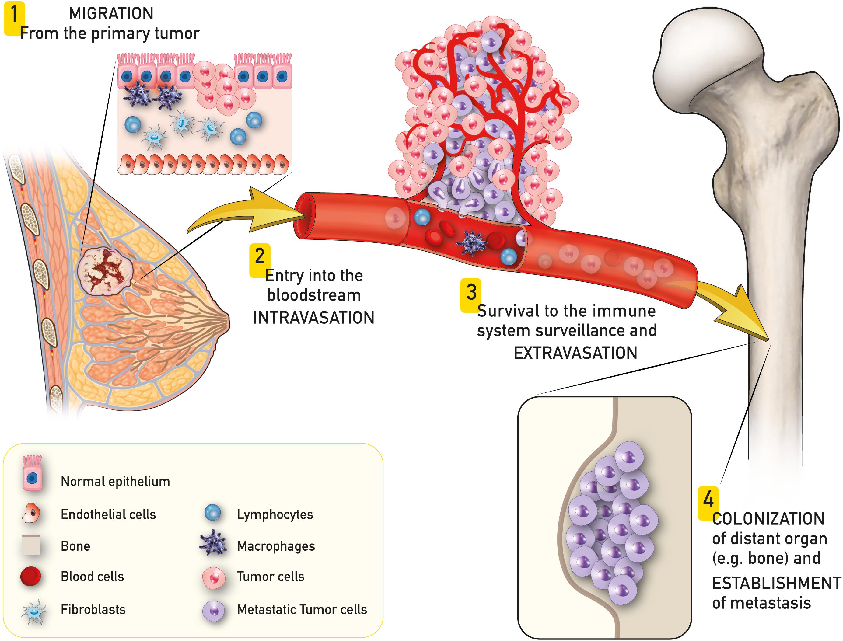 Bone Tumor Surgery