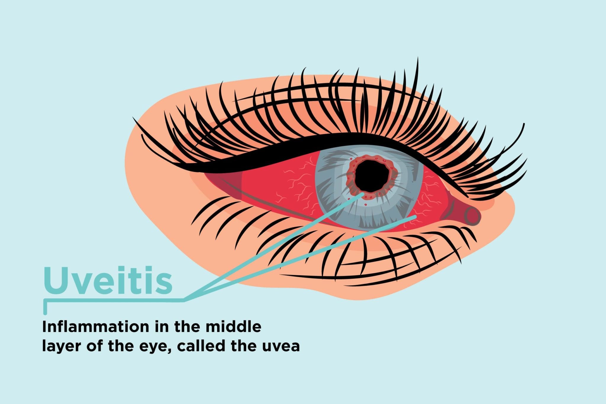 Uveitis Management