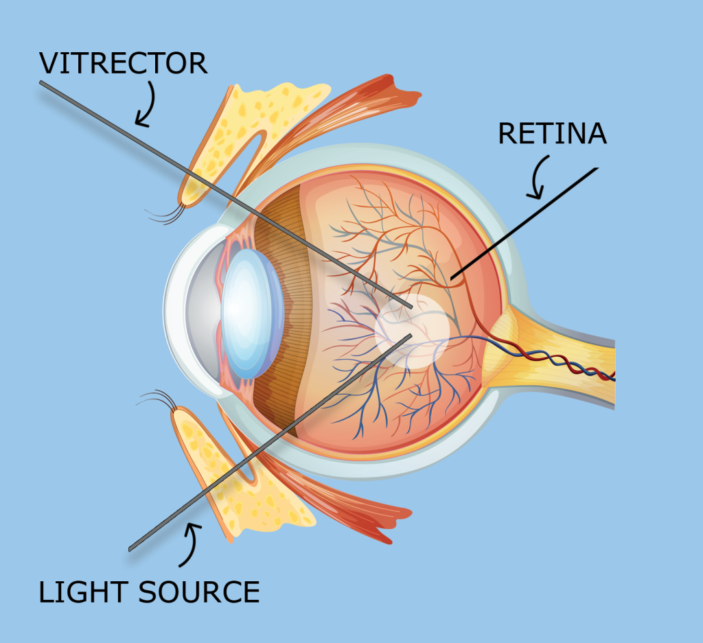 Retina-Vitreous Surgery