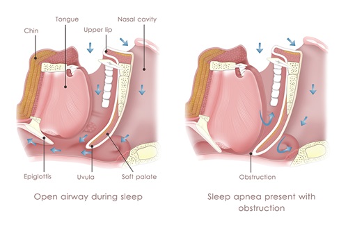 Sleep Apnea Surgery