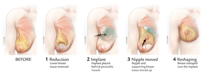 Breast Augmentation