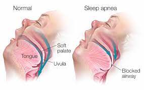 Sleep Apnea Treatment