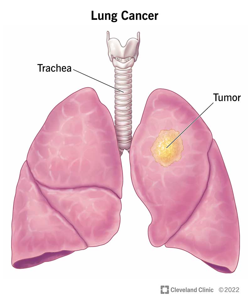 Lung Cancer Treatment