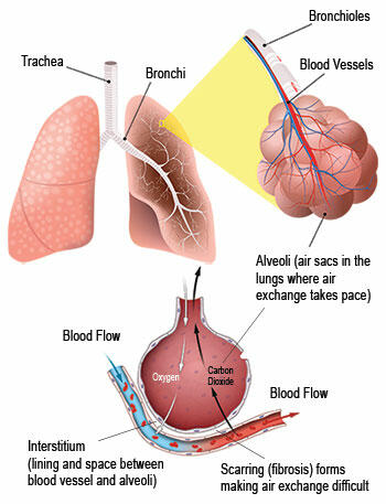 Interstitial Lung Disease Treatment