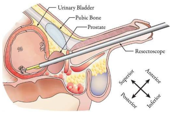 Prostate Surgery (TURP, Radical Prostatectomy)