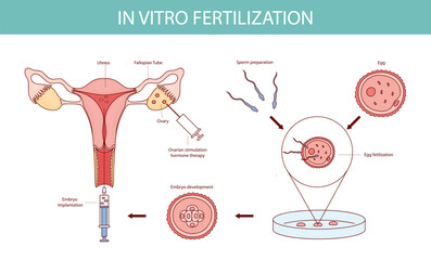 IVF