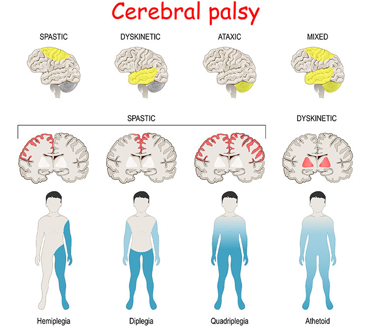 Cerebral Palsy and Neuromuscular Conditions Treatment