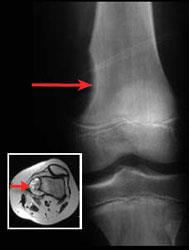 Bone tumors