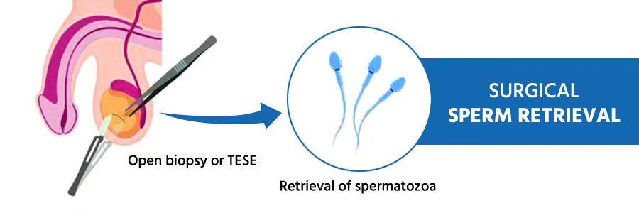 Surgical Sperm Retrieval