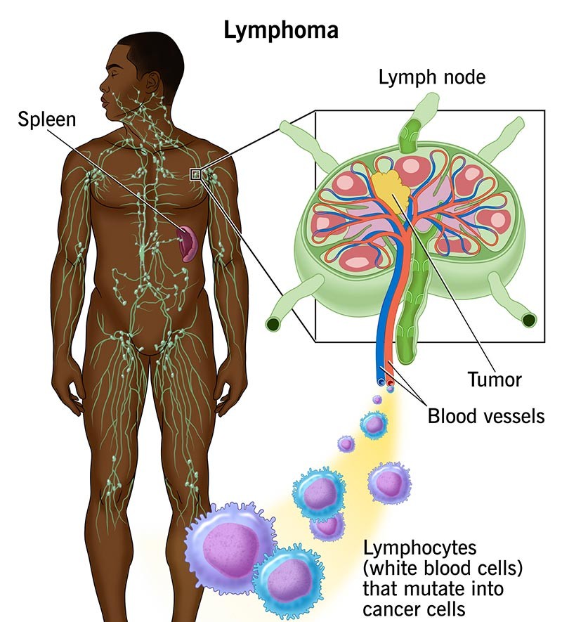 Lymphomas