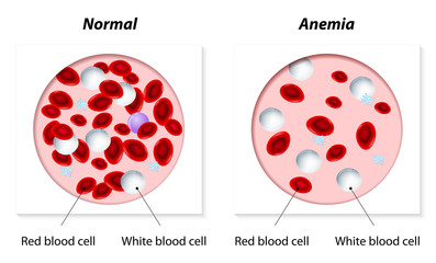 Anaemia